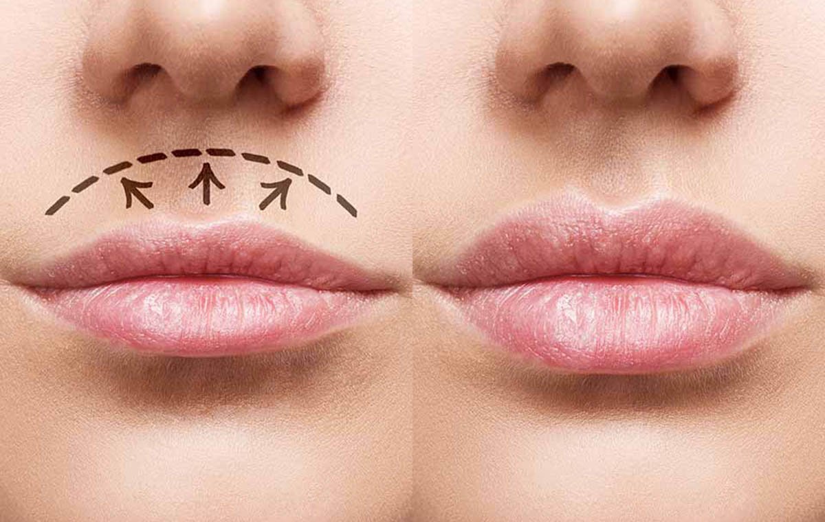 لیفت سانترال لب: راهکاری برای داشتن لب‌های برجسته‌تر و چهره‌ای جوان‌تر