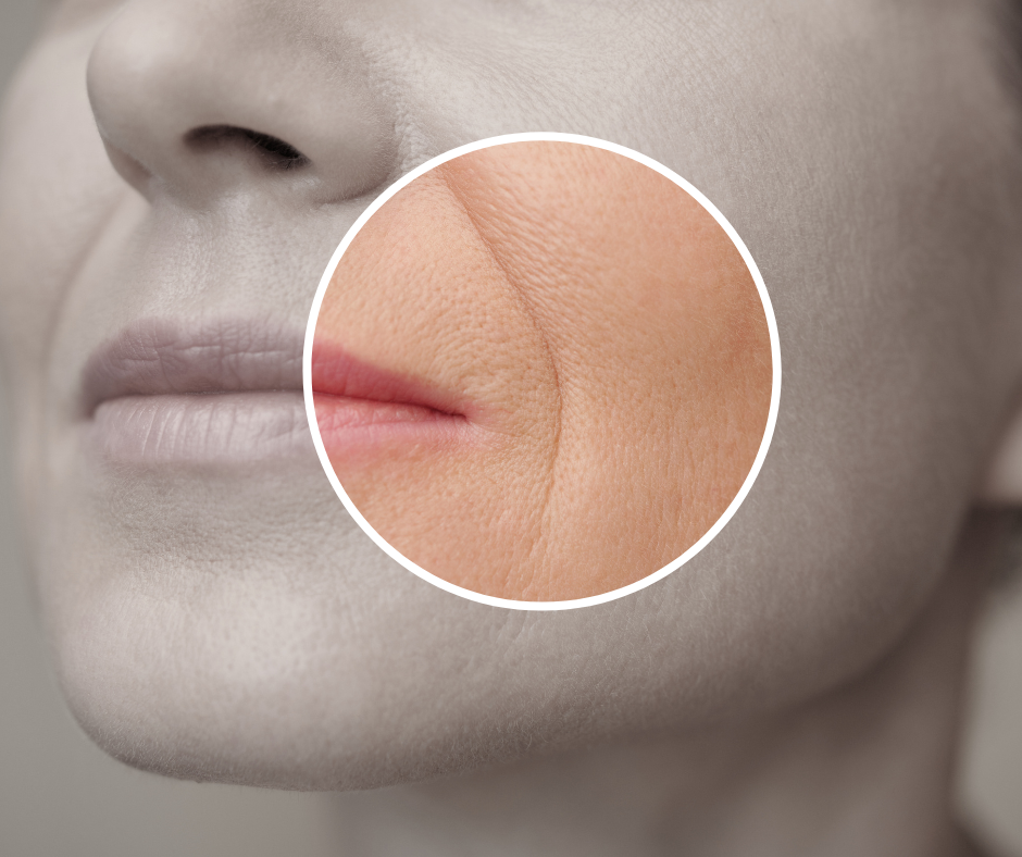 چین نازولبیال چیست؟ از بین بردن خط خنده با تزریق ژل